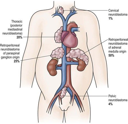 Best Cancer Treatment in India 4 B9781455743339000665 f066 003 9781455743339