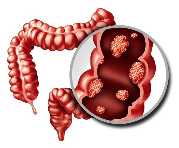 Best Cancer Treatment in India 10 Colon polyps