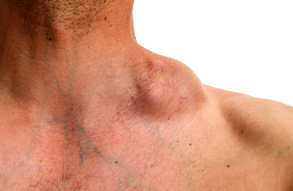 Best Cancer Treatment in India 11 NON HODGKIN