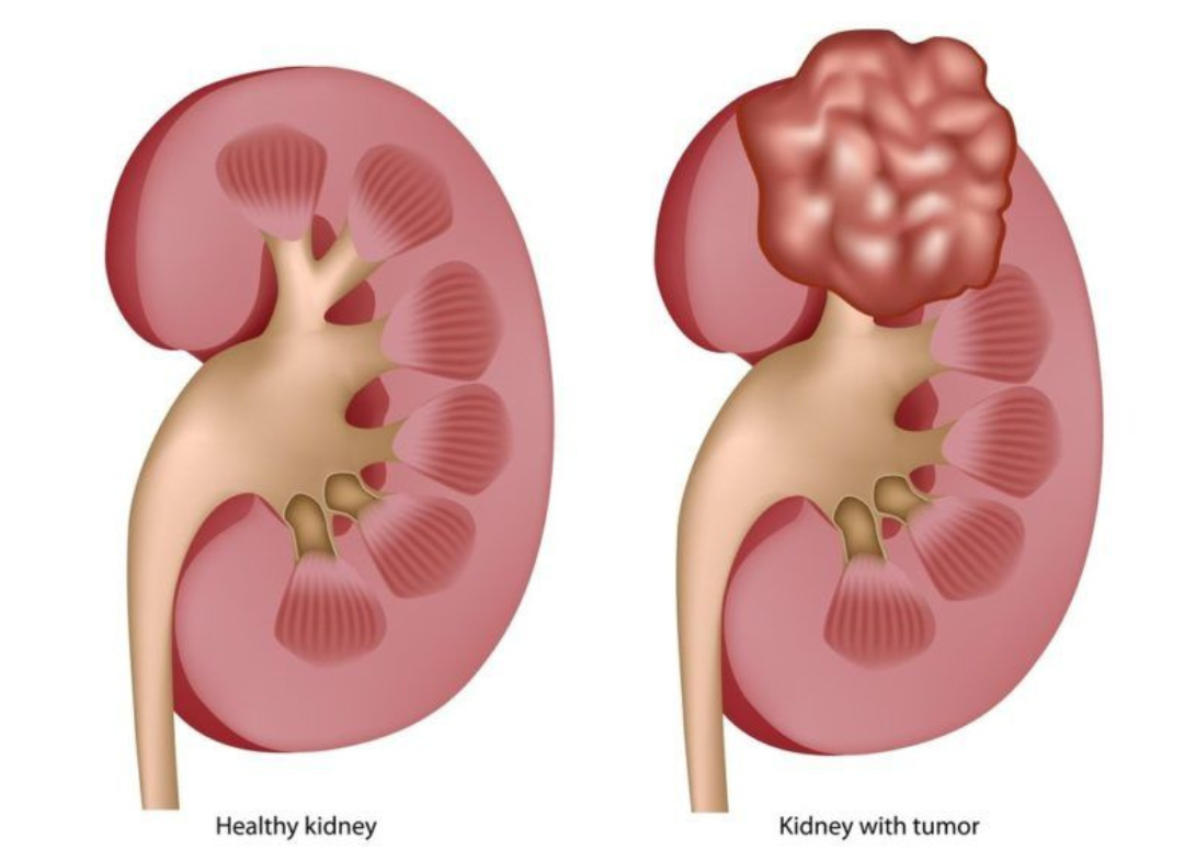 Best Cancer Treatment in India 1 Untitled design 1
