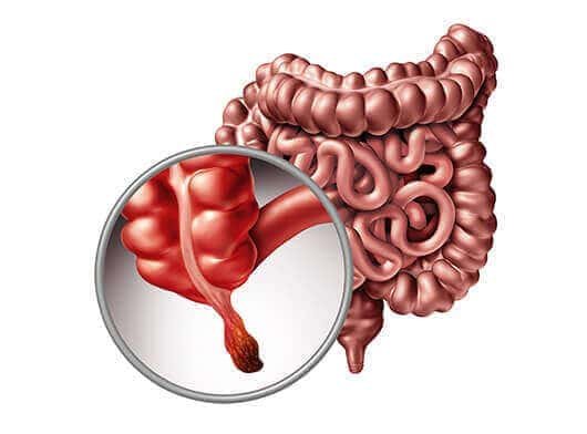 Best Cancer Treatment in India 2 appendix cancer1