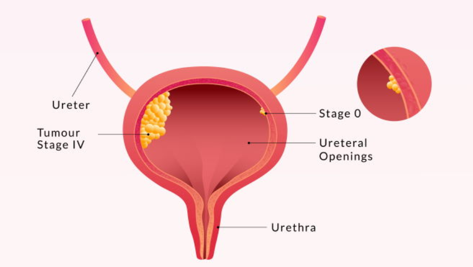 Best Cancer Treatment in India 8 bladder cancer