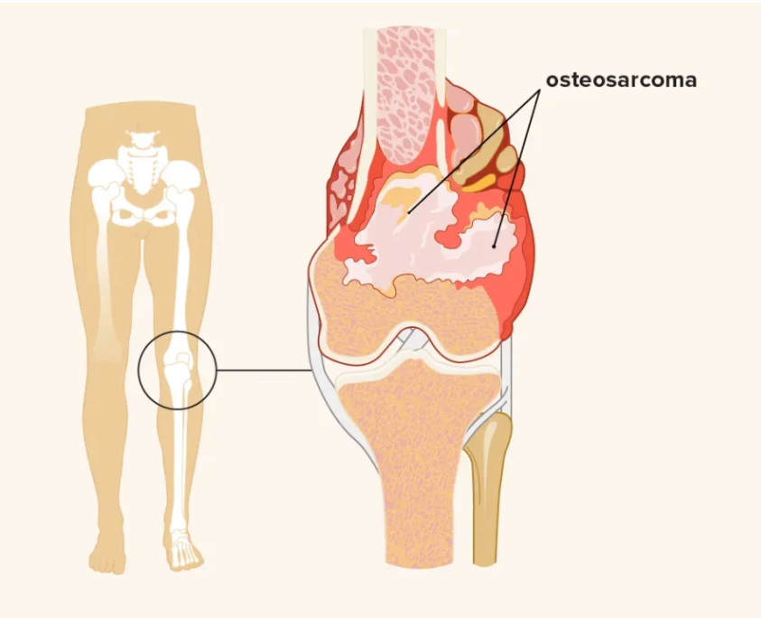 Best Cancer Treatment in India 7 bone