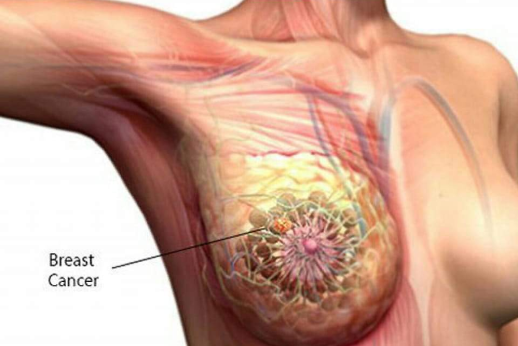 Best Cancer Treatment in India 9 breast cancer