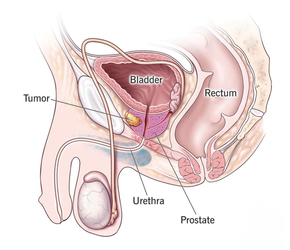 Best Cancer Treatment in India 12 prostate cancer