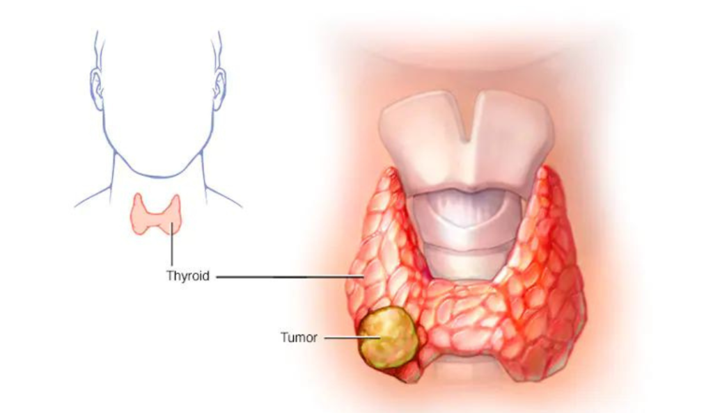Best Cancer Treatment in India 5 thyroid